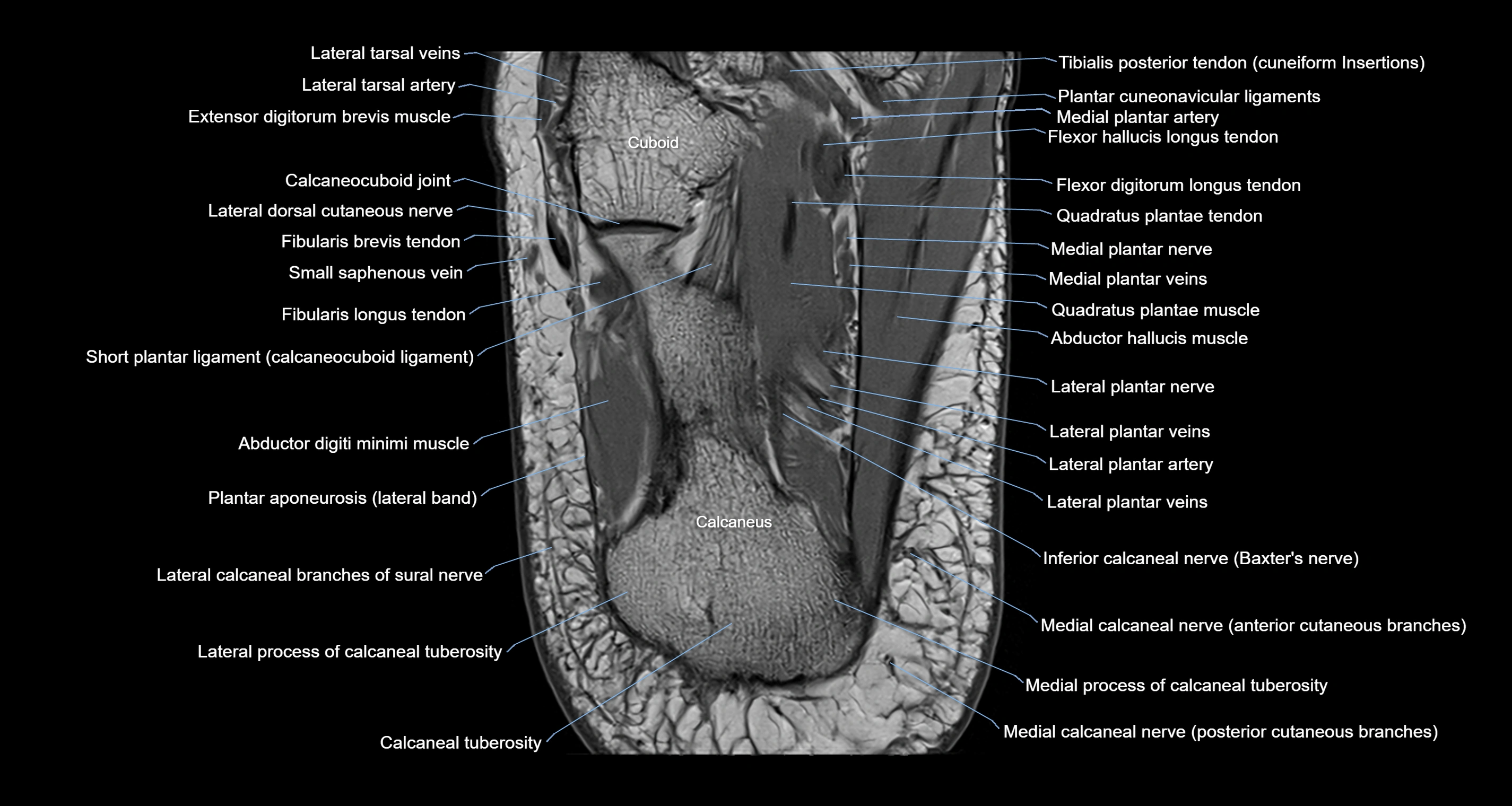 Ankle axial anatomy 3T MRI images -img-10001-00035.webp
